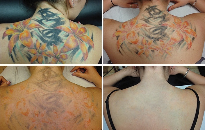 Kom godt i gang Fjernelse af tatoveringer med laser -