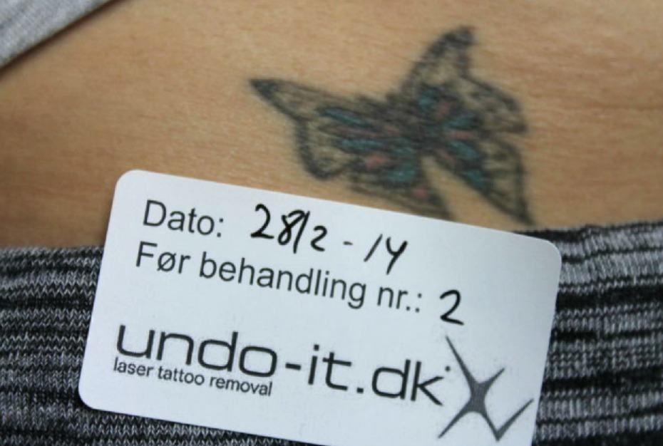 Start af et firma til fjernelse af tatoveringer