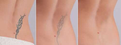 With laser tattoo removal