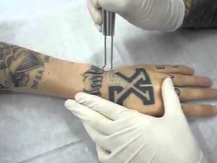 Ismerkedés a tetoválás lézeres eltávolításával -