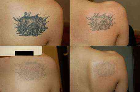 Начало лазерного удаления татуировки